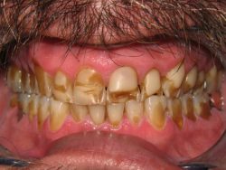 anterior-crowns-before-big