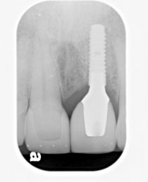 implant-after